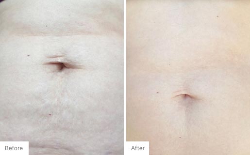 10 - Before and After Real Results photo of someone's belly button.