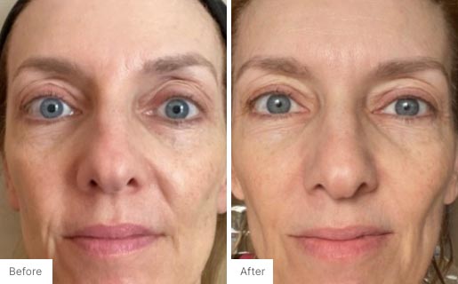 6 - Before and After Real Results photo of a woman's face.