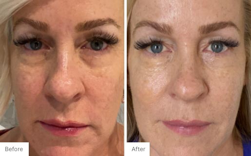 8 - Before and After Real Results photo of a woman's face.