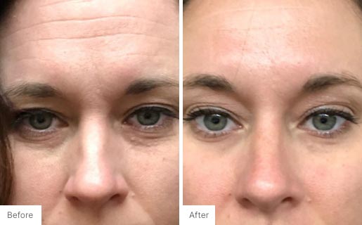 3 - Before and After Real Results of Age IQ Day Cream on a woman's face